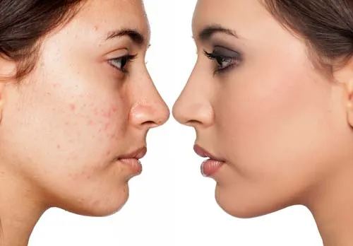 PRP to microneedling