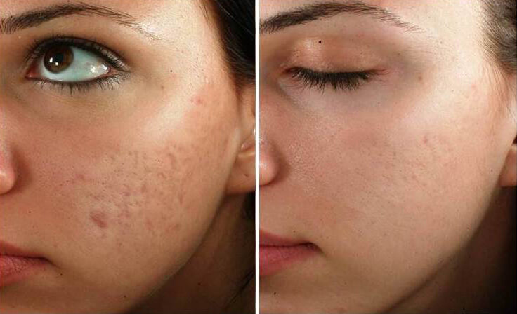 Microneedling Sessions